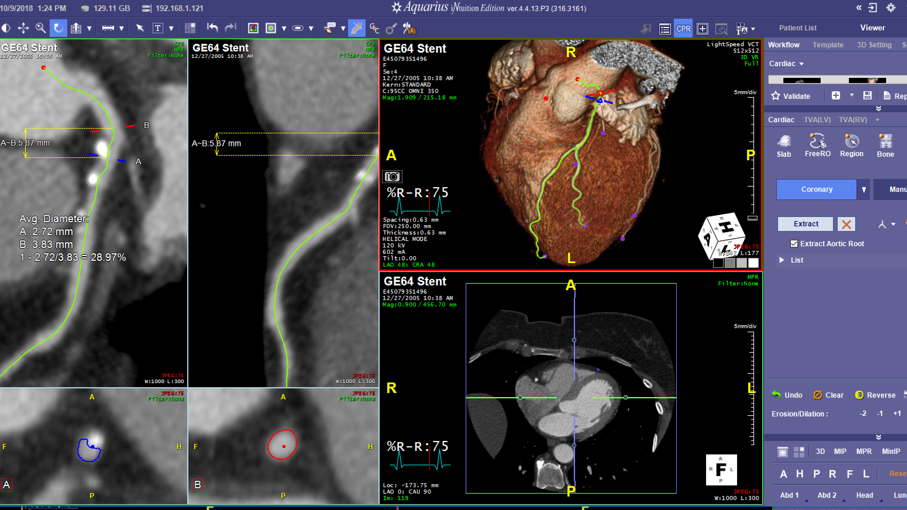CT Cardiac Advanced Visualization Package Terarecon